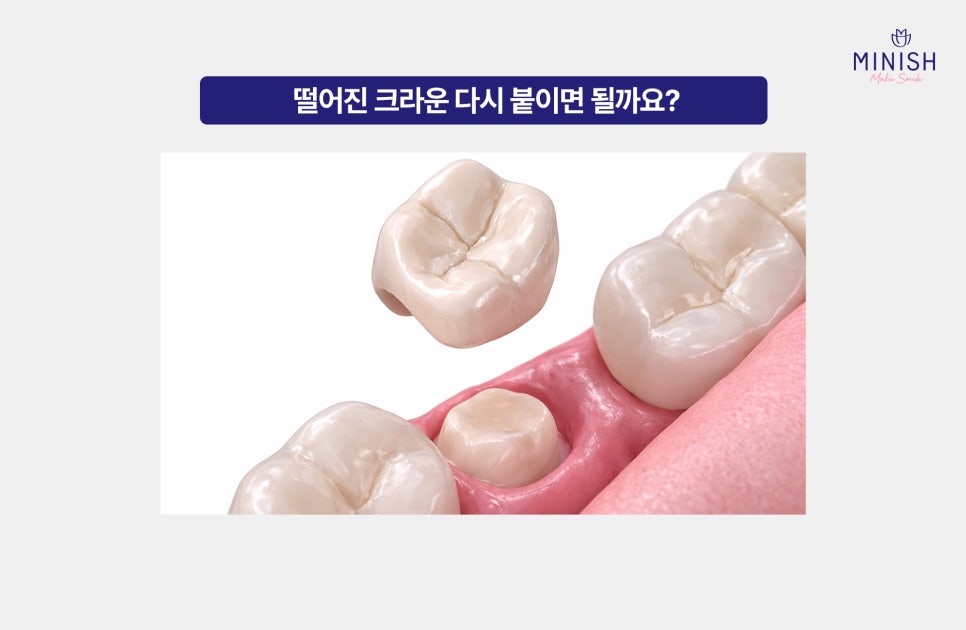 What Happens If You Leave a Fallen Crown Alone? Why You Need to Visit the Dentist Right Away image 4