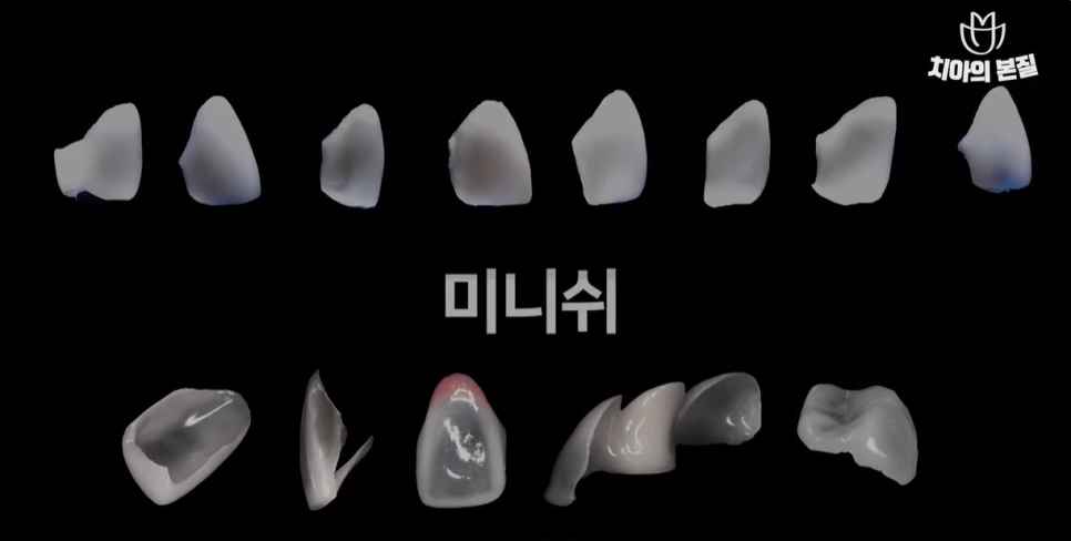 The Specialness of Minish: How to Restore Teeth in One Day! image 2