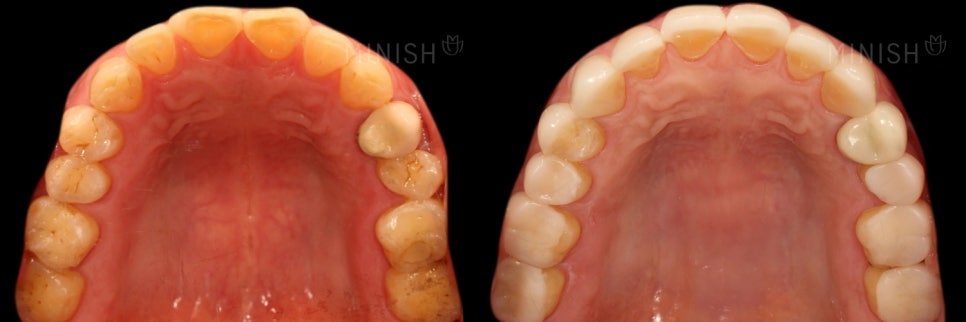 The Difference Created by Technology: A Complete Comparison of Minish vs. Laminate image 4