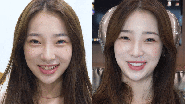 치아 콤플렉스? 치아성형 대신 미니쉬 관련 이미지 1