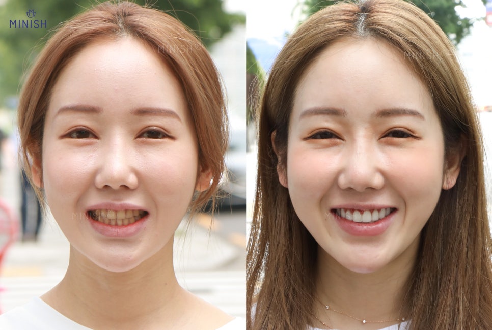 누런니 고민은 치과 치아미백 아닌 원데이미니쉬 관련 이미지 1