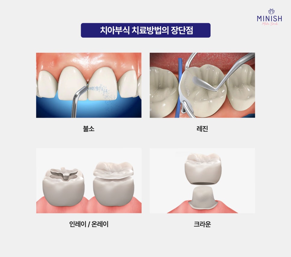 Why Teeth Wear Down Over Time: Causes of Tooth Erosion and How to Address It image 4