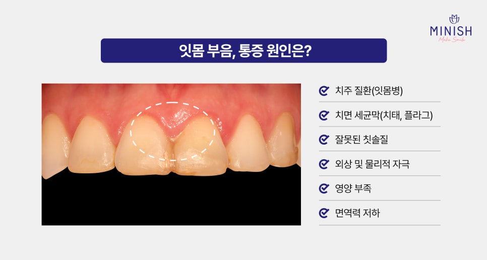 잇몸 부음 왜 생길까? 통증 반복될 때 꼭 확인해야 할 것 관련 이미지 3