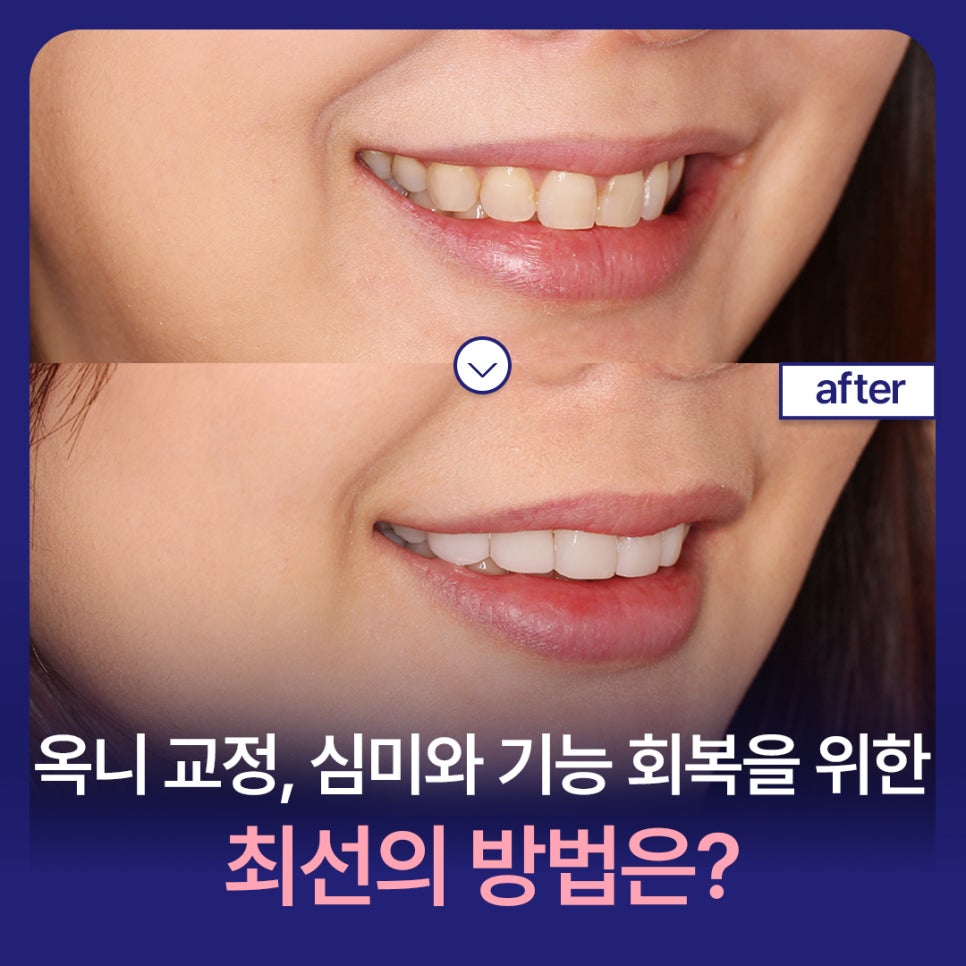 들어간 입, 합죽이 입 옥니 교정 심미와 기능 회복을 위한 최선의 방법은? 관련 이미지 1
