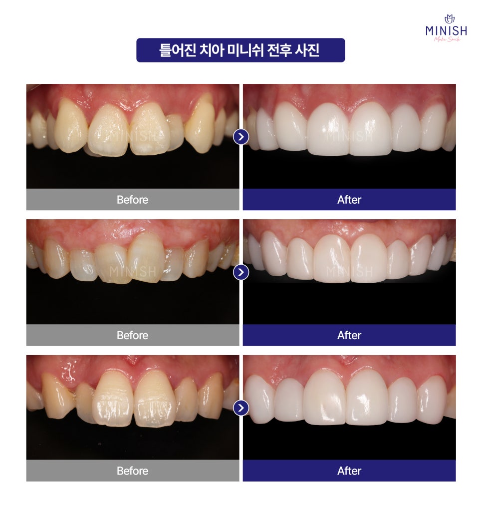 Why You Shouldn’t Leave Crooked Teeth Untreated? A Way to Improve Them in Just One Day! image 4
