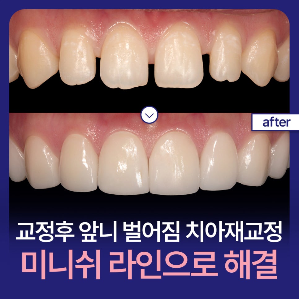 Gaps Between the Front Teeth After Orthodontic Treatment: Addressing Them with the Minish Line image 1