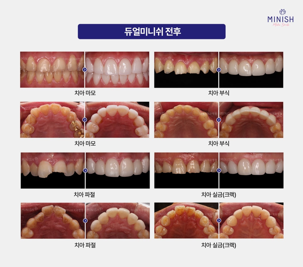 From Front Teeth to Molars, Which Minish Is Right for My Dental Condition? image 4