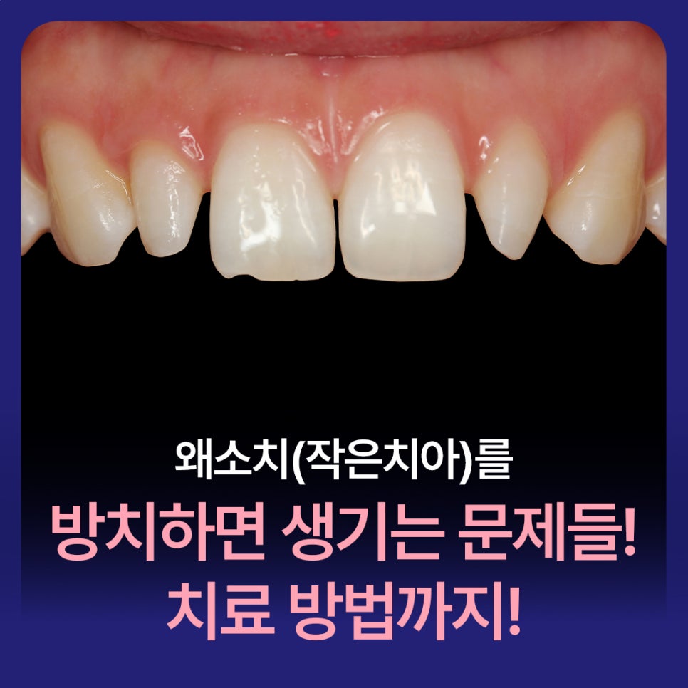 Problems That Occur If Small Teeth (Microdontia) Are Left Untreated! Treatment Methods Too! image 1