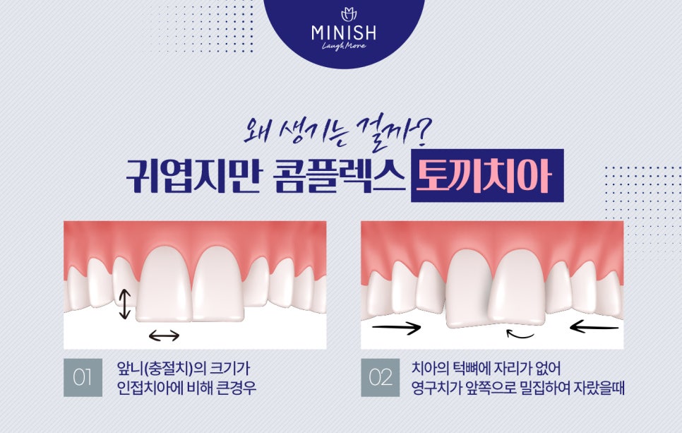 도드라지는 토끼치아 콤플렉스 미니쉬치과병원에서 앞니교정으로! 관련 이미지 3