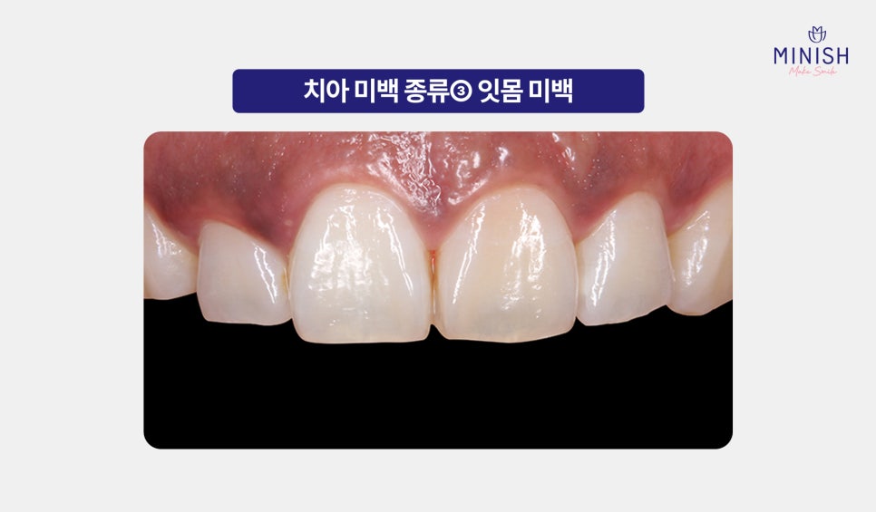 Yellow Teeth Concerns: Teeth Whitening Methods That Vary by Cause image 13