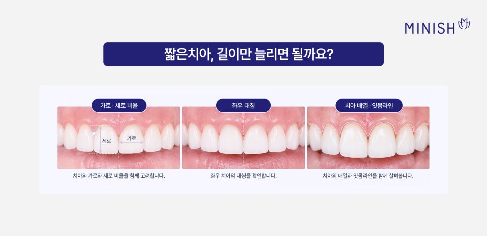 앞니가 짧아 보인다면? 짧은치아 원인과 앞니 미니쉬 관련 이미지 3
