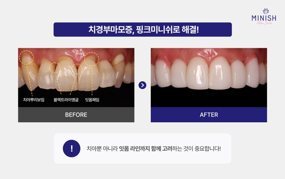 Cervical Abrasion, Causes of Exposed Tooth Roots, and Treatment for Gum Indentations image 7