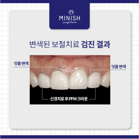 크라운치료의 거의 모든 것 관련 이미지 4