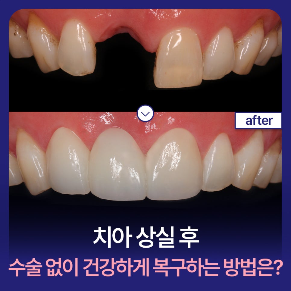 How Can You Restore Healthy Teeth After Tooth Loss Without Surgery? image 1