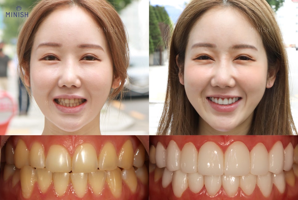 누런니 고민은 치과 치아미백 아닌 원데이미니쉬 관련 이미지 7