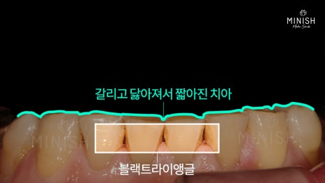 [Tooth Aging] Do Teeth Age, Too? Restoring Them Healthily with Minishe image 5