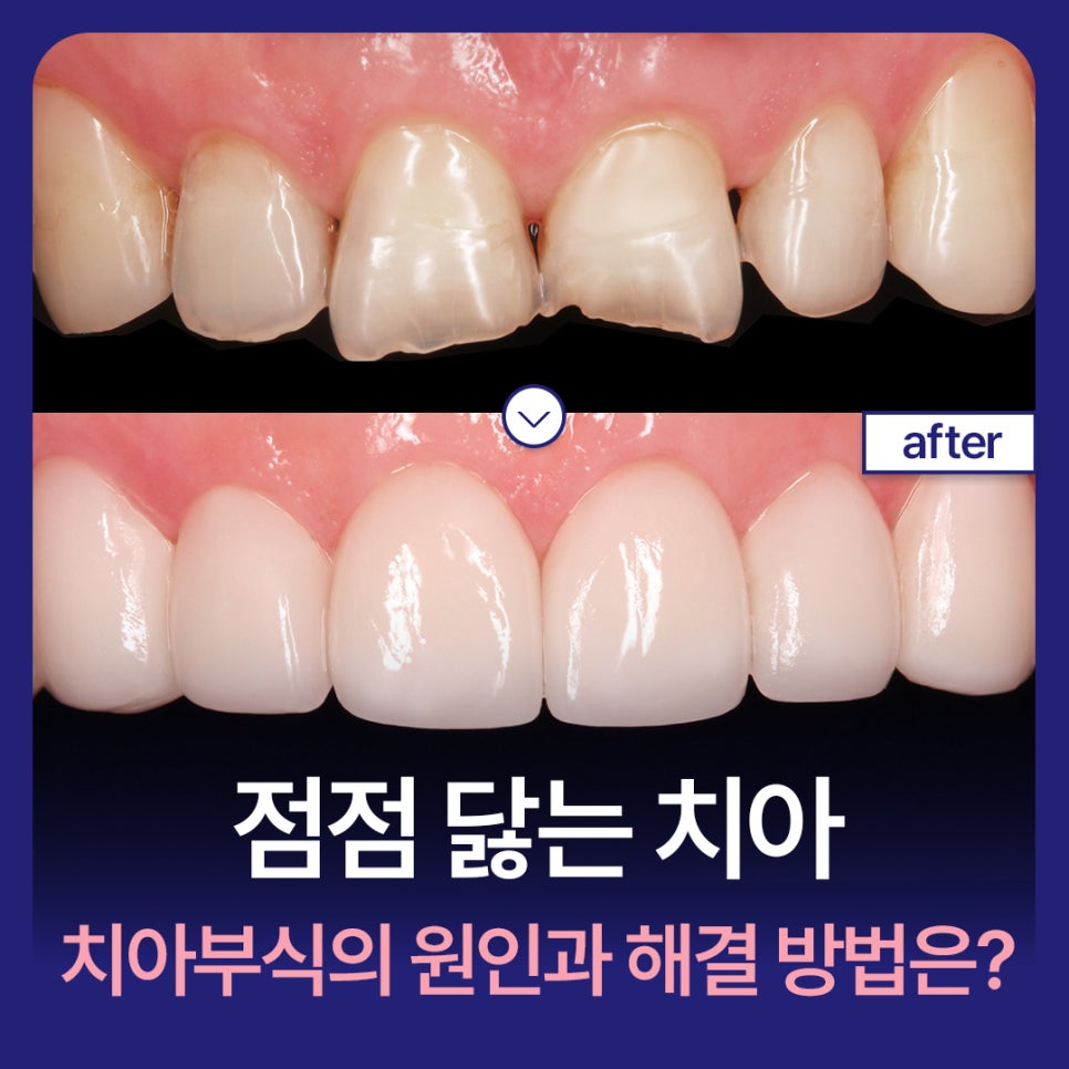 Why Teeth Wear Down Over Time: Causes of Tooth Erosion and How to Address It image 1