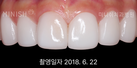 입냄새 원인 별 예방과 제거 치료 방법은? 관련 이미지 8