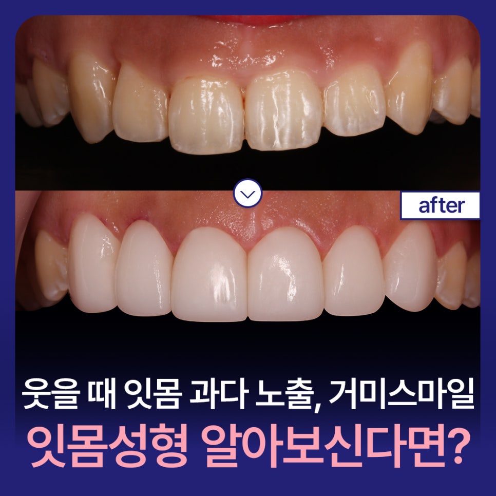 웃을 때 잇몸 과다 노출, 거미스마일 잇몸성형 알아보신다면? 관련 이미지 1