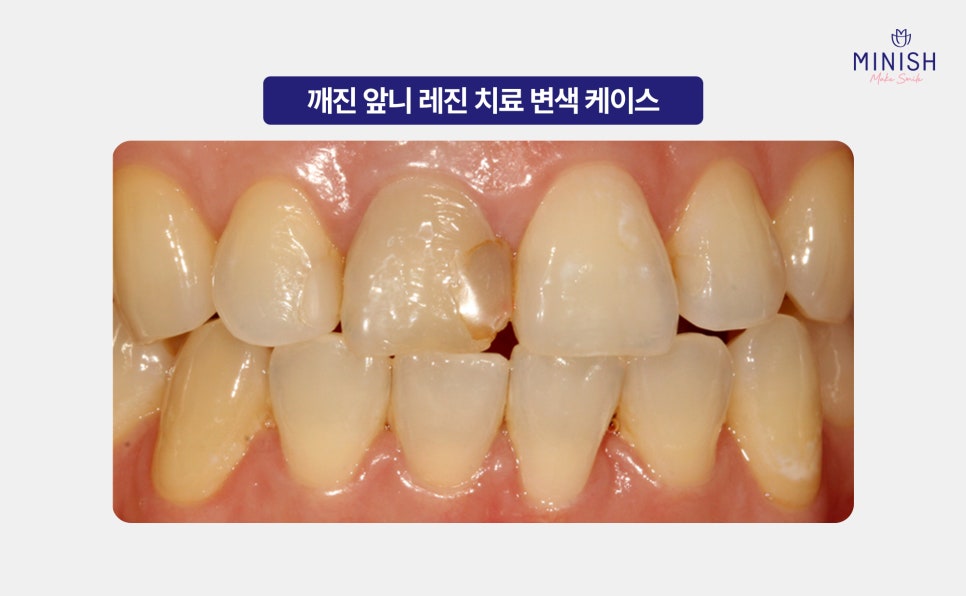 앞니깨짐 레진 치료의 한계와 치아복구솔루션 미니쉬 특장점 관련 이미지 3
