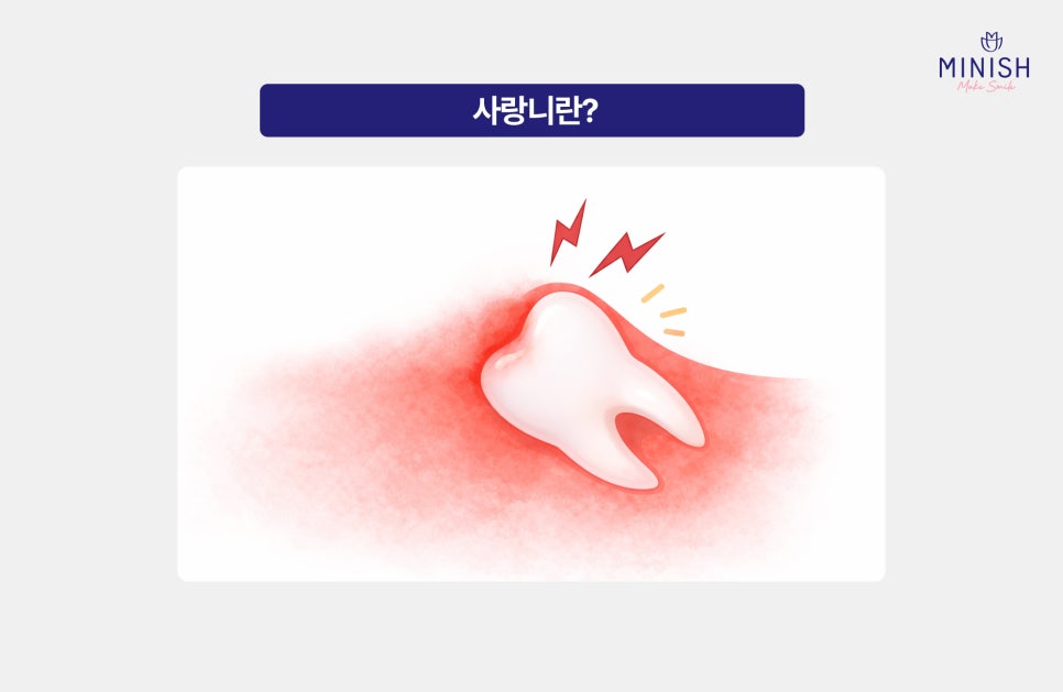 Do Wisdom Teeth Have to Be Extracted? image 2