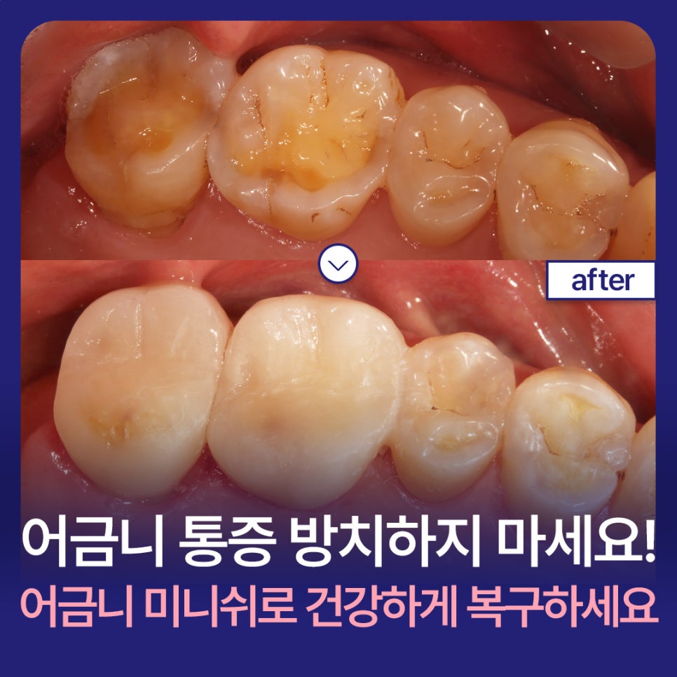Don’t Ignore Molar Pain! Molar Minishe Can Restore Them Healthily image 1