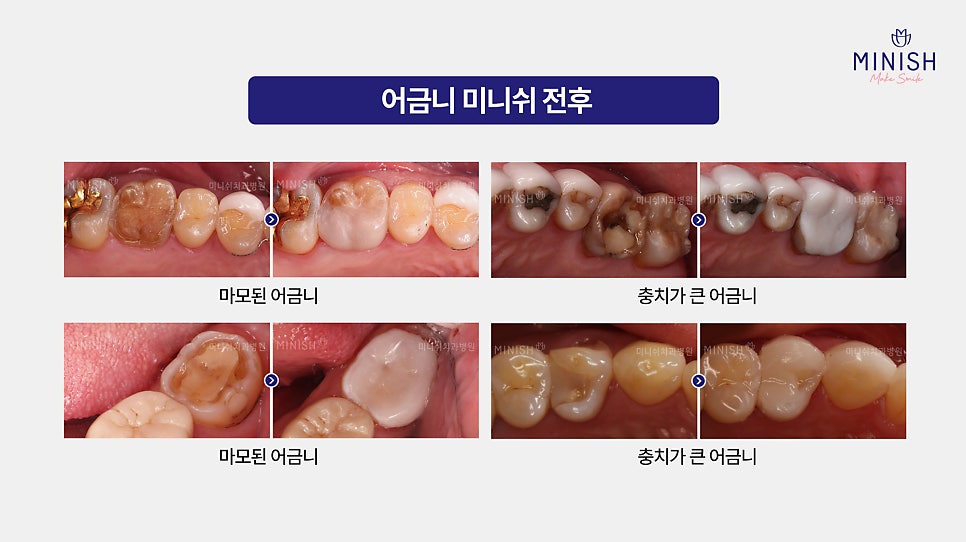 From Front Teeth to Molars, Which Minish Is Right for My Dental Condition? image 14