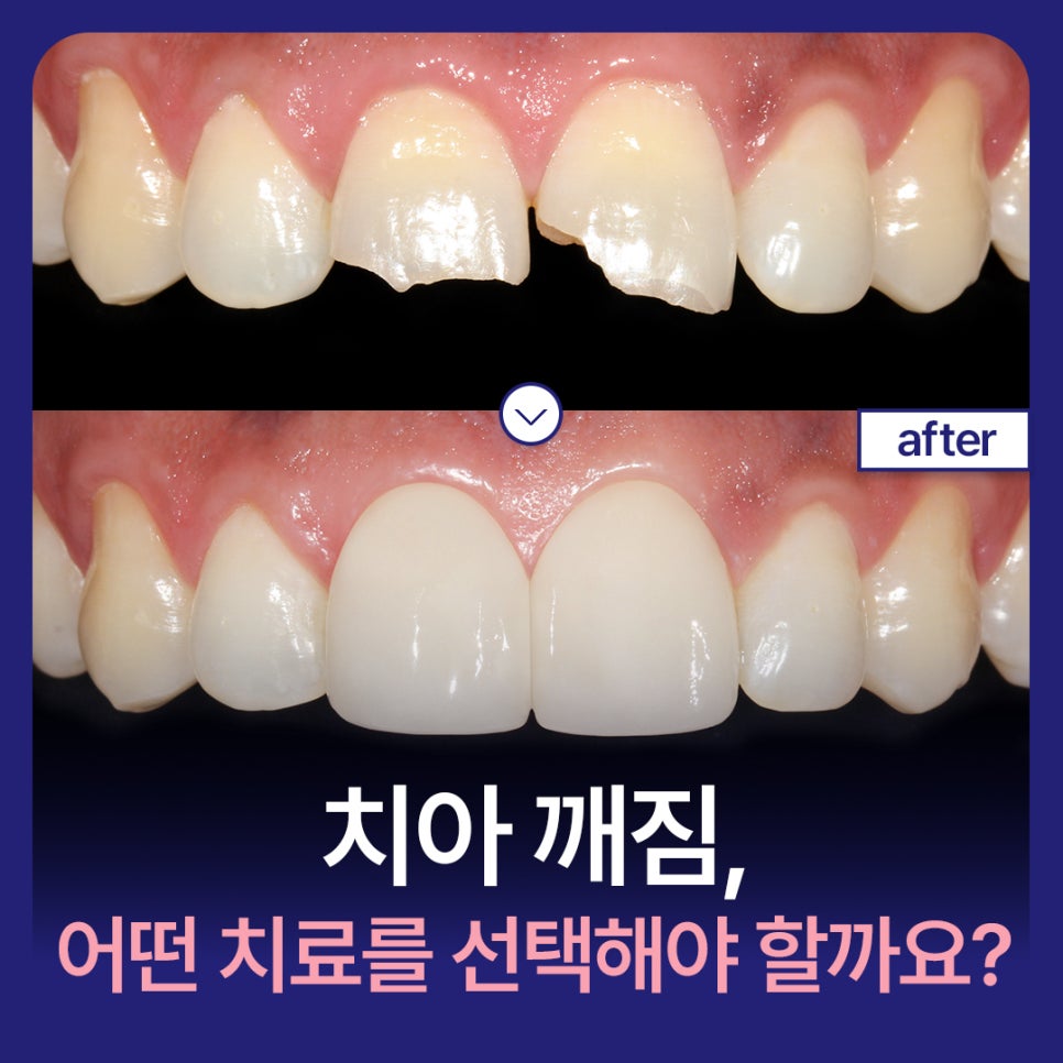 A Chipped Tooth: Which Treatment Should You Choose? A Comparison of Pros and Cons image 1