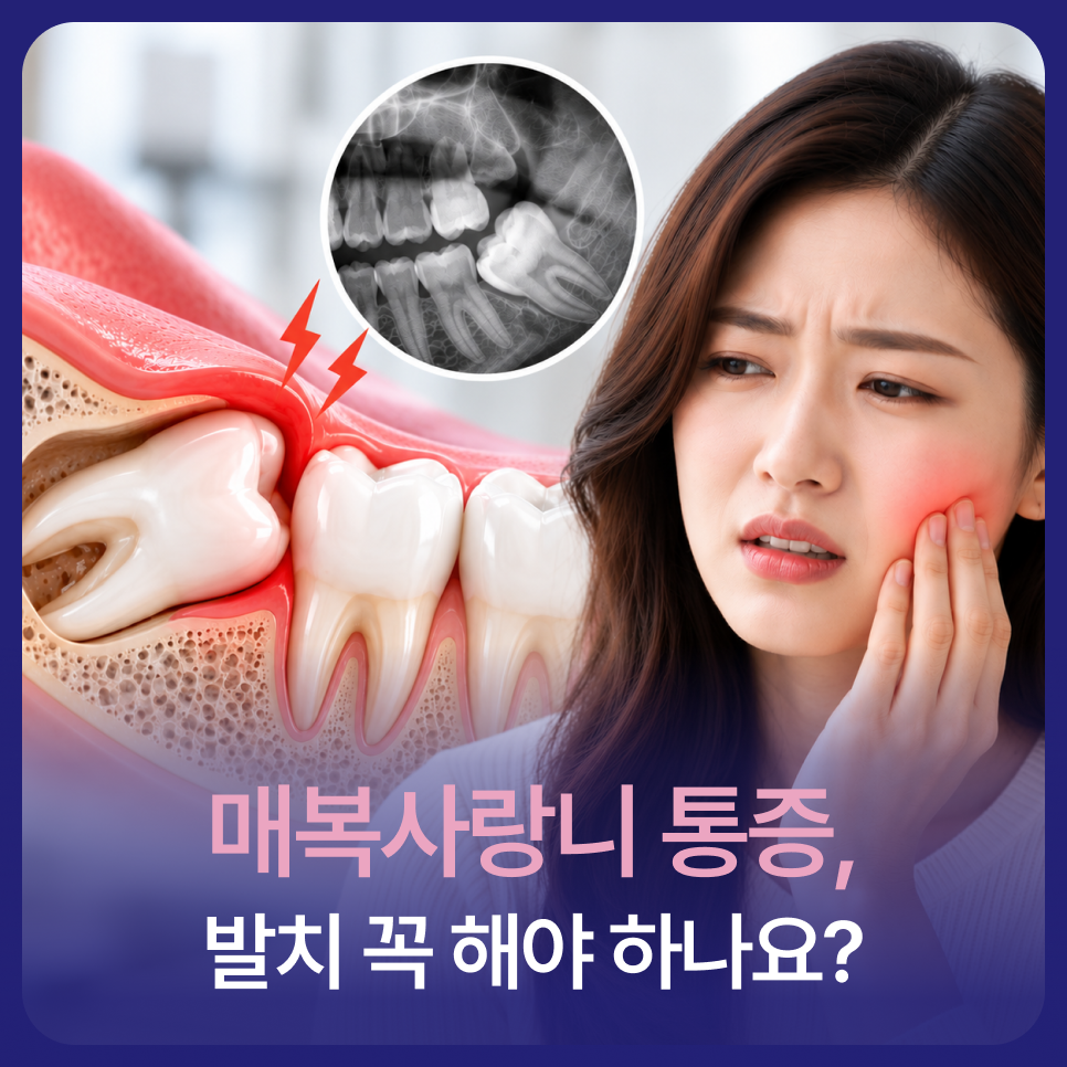 매복사랑니 통증, 발치 꼭 해야 하나요? 관련 이미지 1