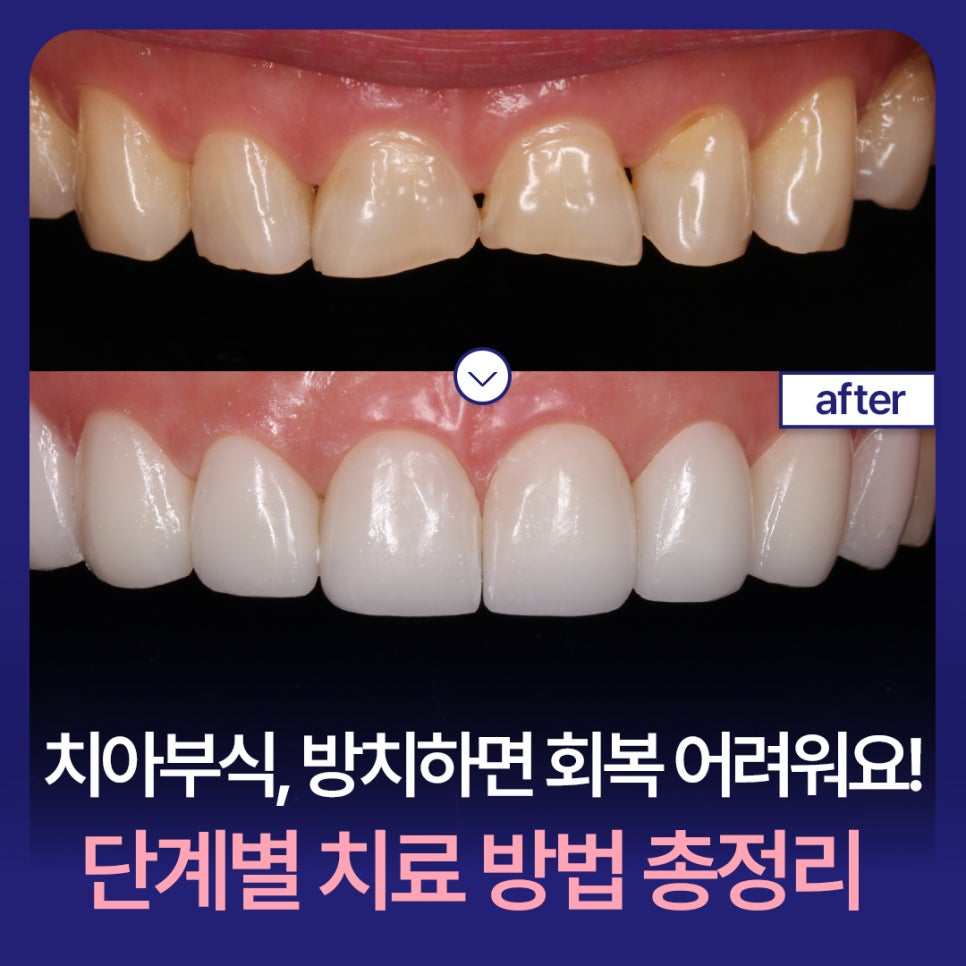 Tooth Erosion: If Left Untreated, It’s Hard to Recover! A Complete Guide to Treatment by Stage image 1