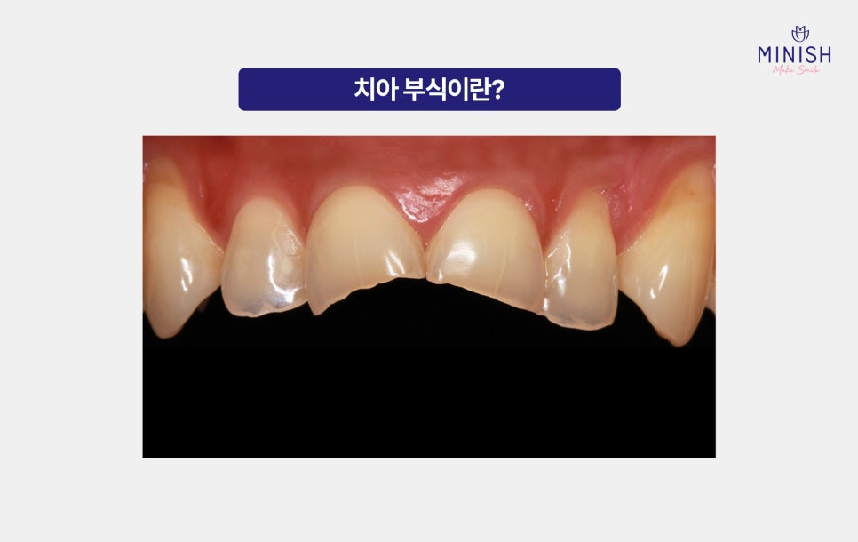 Why Teeth Wear Down Over Time: Causes of Tooth Erosion and How to Address It image 2