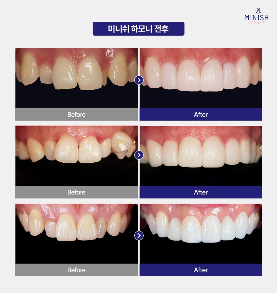 If You Want to Improve Irregular Teeth in Just One Day Without Orthodontics image 5