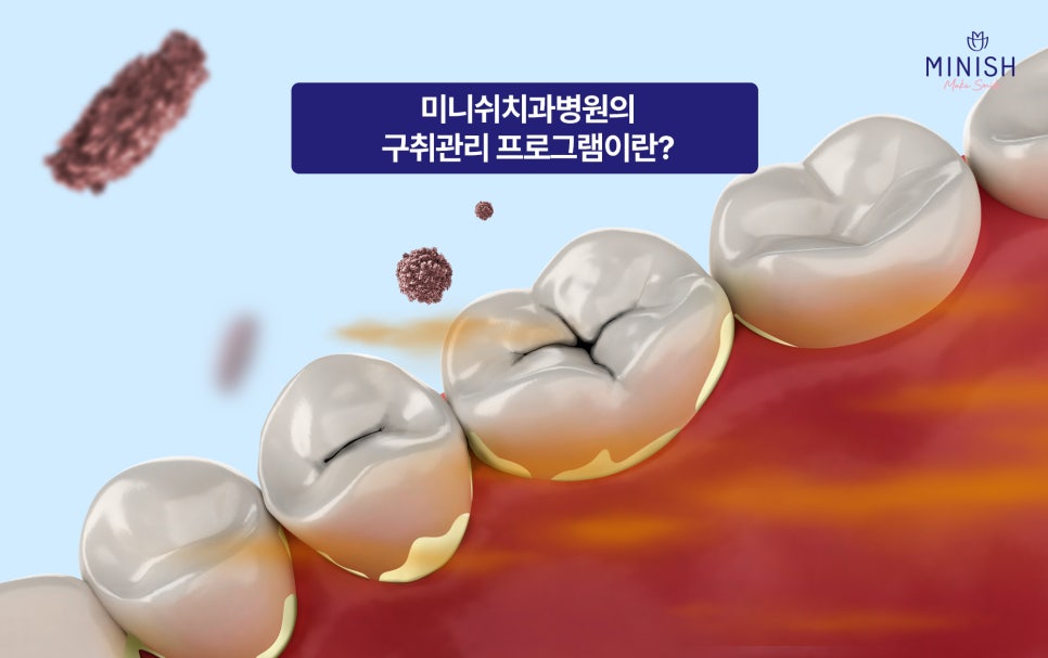 Customized Solutions for Different Dental Concerns: What Oral Care Programs Does Minish Dental Hospital Offer? image 6