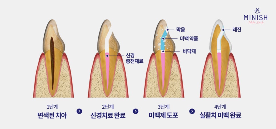 누런 치아? 치아변색 원인과 치료방법은? 관련 이미지 5