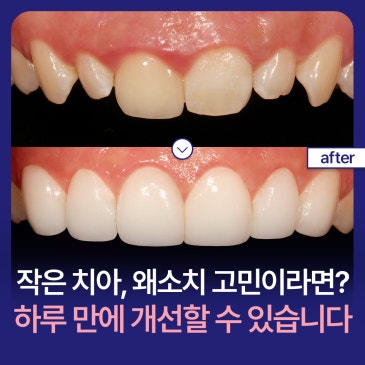 작은 치아, 왜소치 고민이라면? 하루 만에 개선할 수 있습니다
