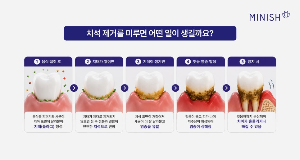 치석 제거 안 하면? 잇몸병 단계별 증상 및 치료 방법 관련 이미지 2