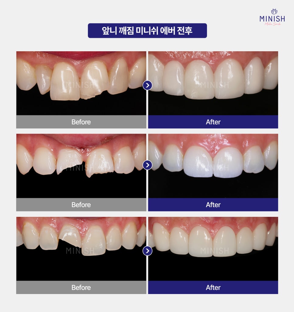 Sudden Chipped Front Tooth? Don’t Panic—Restore It with One-Day Minish! image 6