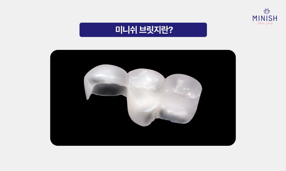 From Front Teeth to Molars, Which Minish Is Right for My Dental Condition? image 8