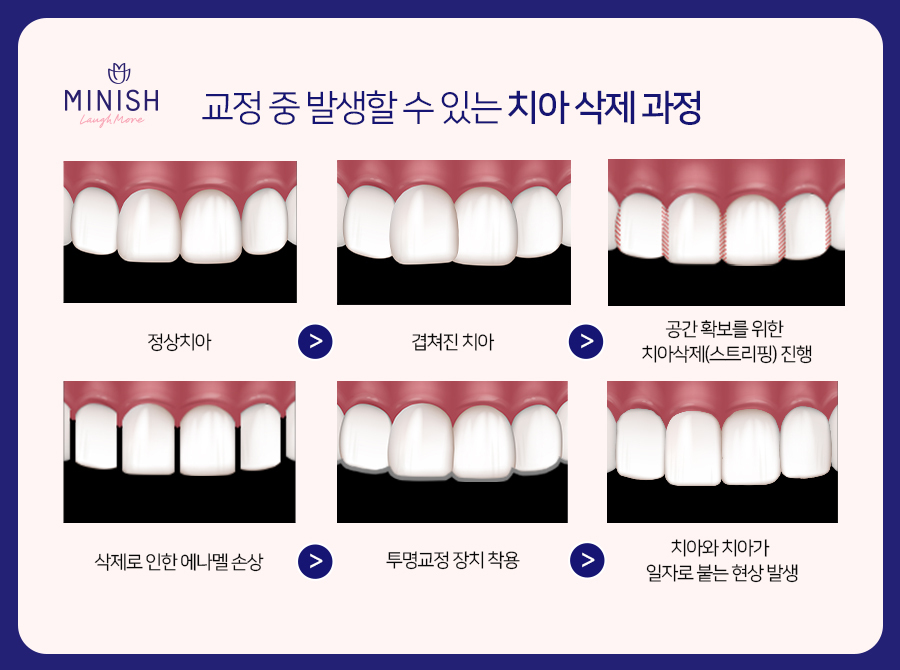 치아교정 고민, 미니쉬하모니로 관련 이미지 6