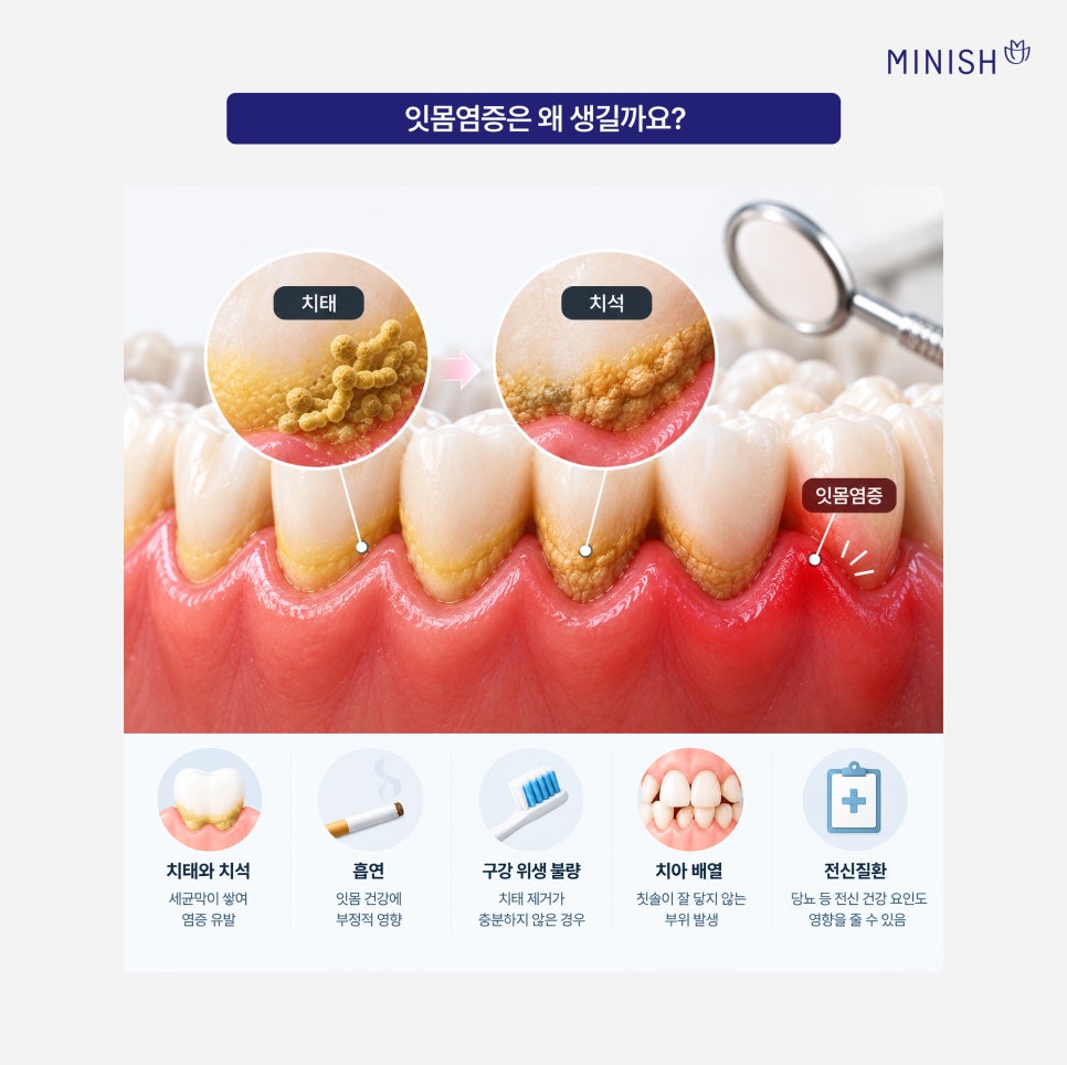 잇몸염증, 잇몸 부었을 때 필요한 치료는? 관련 이미지 2