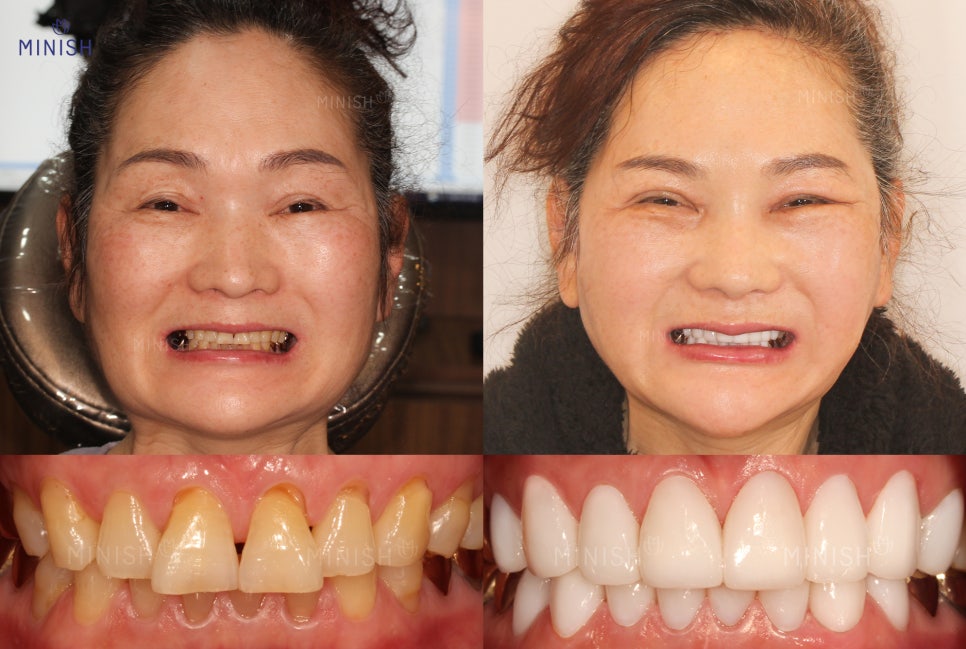 치아마모, 벌어짐 등 노화 증상을 겪는 50대를 위한 학동치과 관련 이미지 10