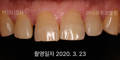 누런치아, 치아 미백으로 해결되지 않을 땐? 관련 이미지 8