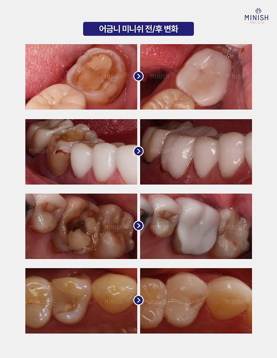 Caused by Cavities? A Complete Guide to Why Molars Break and How to Treat Them image 7