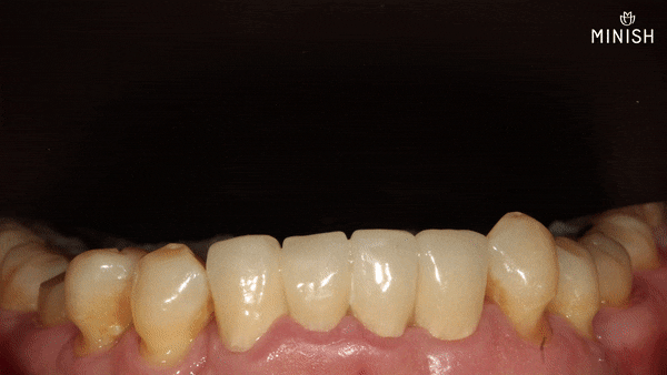 Protruding Front Teeth: How to Restore Both Health and Aesthetics When Crown Retreatment Is Needed! image 3