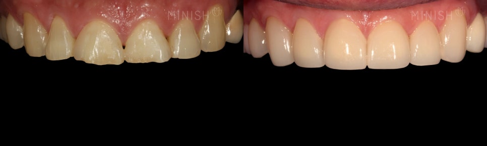 The Difference Created by Technology: A Complete Comparison of Minish vs. Laminate image 3