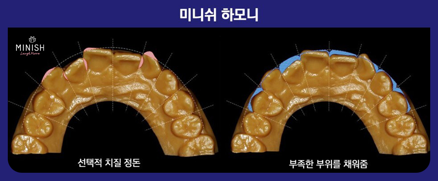 치아교정 고민, 미니쉬하모니로 관련 이미지 9