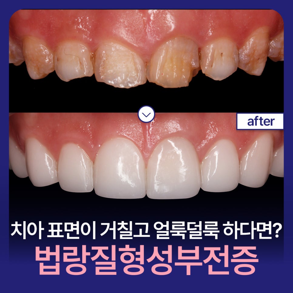 치아 표면이 거칠고 얼룩덜룩하다면? 법랑질형성부전증 관련 이미지 1