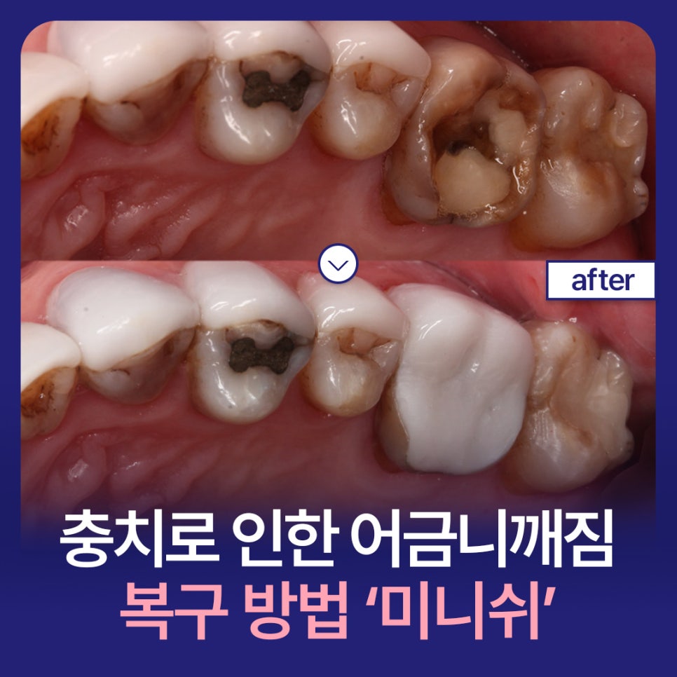 Caused by Cavities? A Complete Guide to Why Molars Break and How to Treat Them image 1