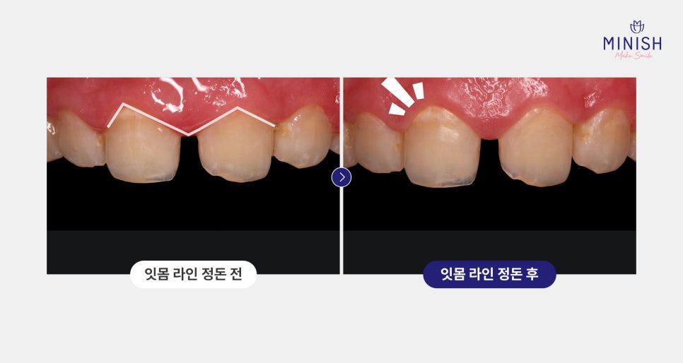 교정 후 앞니 벌어짐, 미니쉬로 해결하세요! 관련 이미지 4