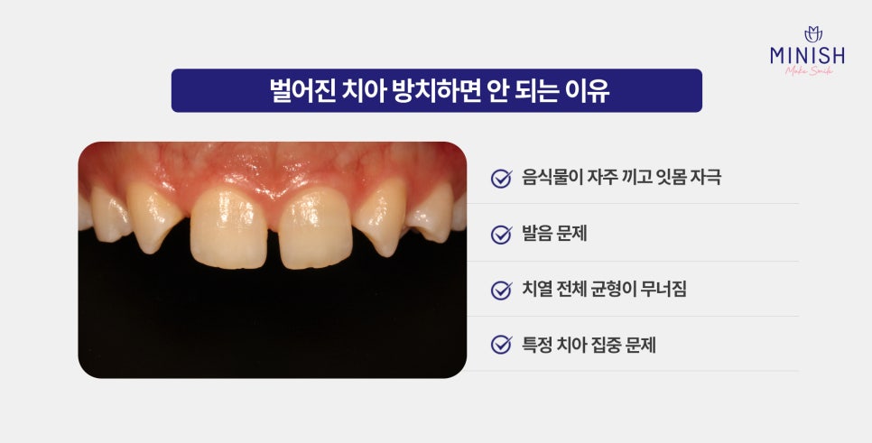 Worried About Gaps Between Your Teeth? Solve It Quickly with Minish While Protecting Your Natural Teeth! image 3